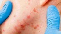 acne on the chin causes