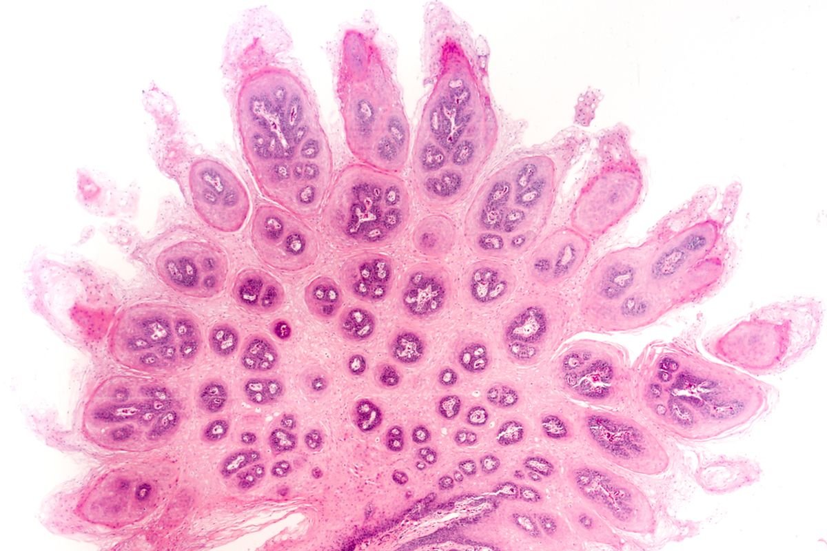 Terinfeksi HPV